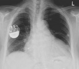 Jako první v ČR implantovali lékaři v Praze 10 převratný kardiostimulátor