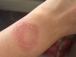 Watch popálily kůži, Apple zdržuje řešení, majitele tahá od čerta k ďáblu