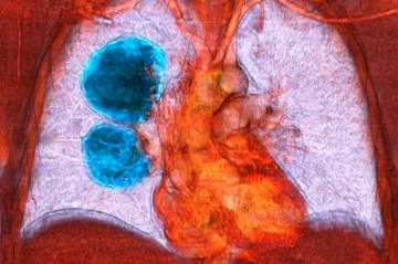 Včasné vyšetření a testování nádoru může snížit úmrtí na rakovinu plic
